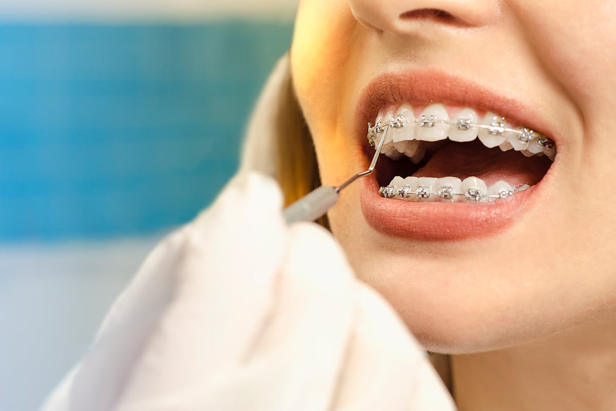 Can adults get braces benefits treatment options and what to expect blog