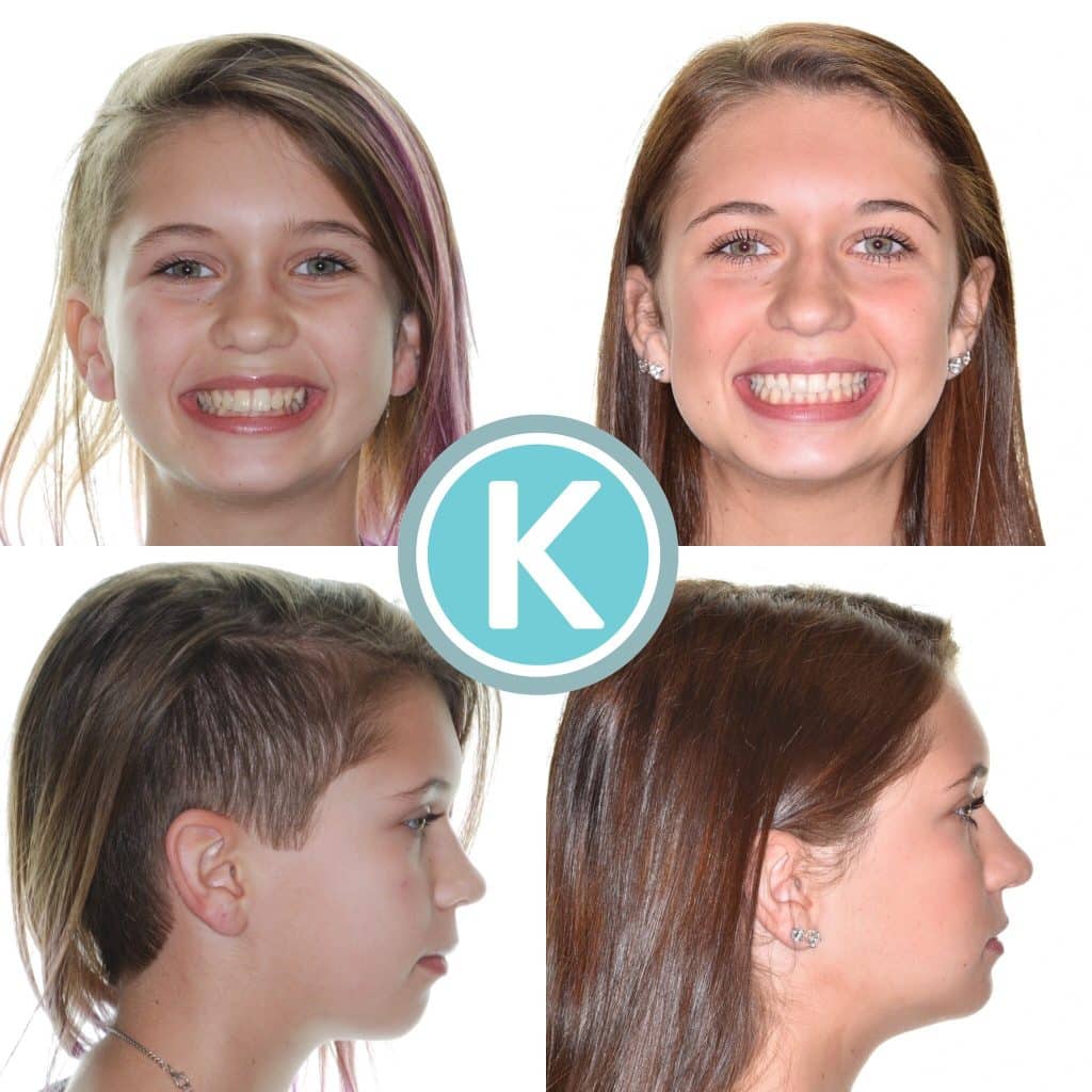 Kragor ortho before after jaw