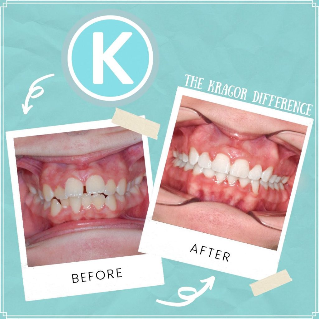 Kragorbeforeafter0811