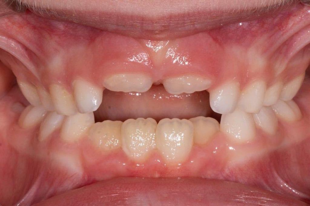 Open bite 1024x682 1