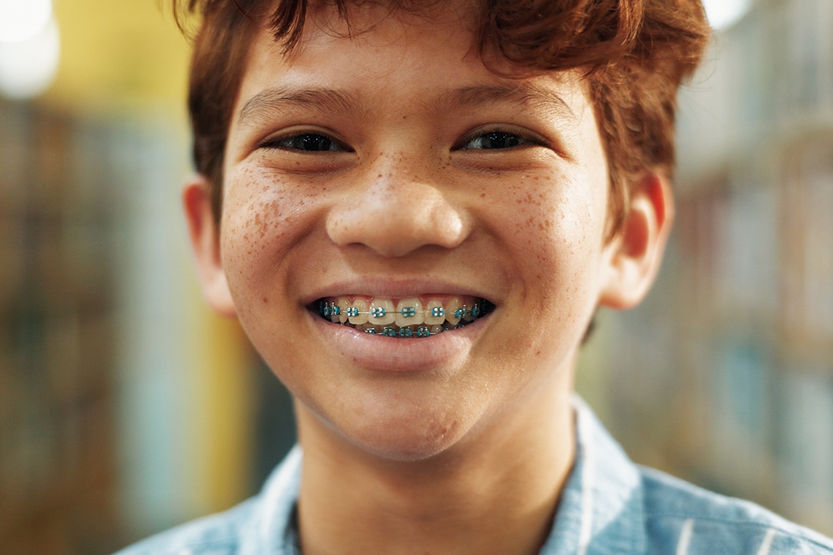 When should kids get braces age guidelines for parents blog